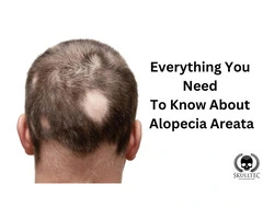Alopecia Areata Solutions with SMP and Boost Confidence