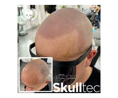 Scalp Micropigmentation by Skulltec in Glasgow