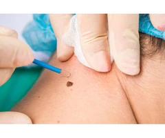 Seeking Genital Warts Removal in London? Visit London Dermatology Clinics!