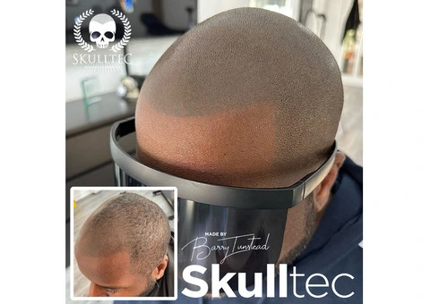 Scalp Micropigmentation in Glasgow