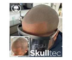 Scalp Micropigmentation in Glasgow
