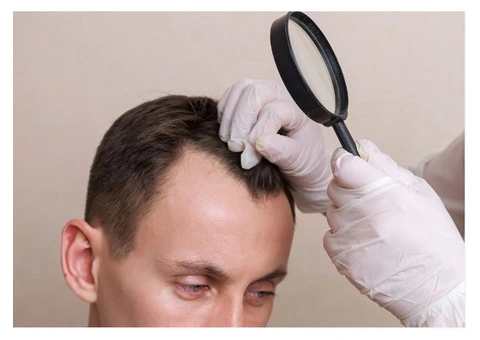 Hair Transplant Solutions in Newcastle