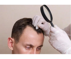 Hair Transplant Solutions in Newcastle