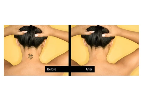 Best Laser Tattoo removal in Birmingham UK