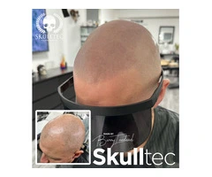 Scalp Micropigmentation For Men