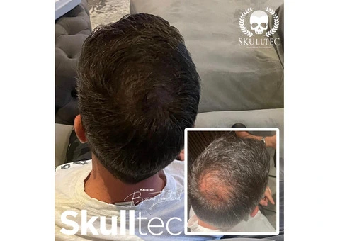 Hair Loss Solutions For Men in The UK