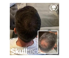 Hair Loss Solutions For Men in The UK