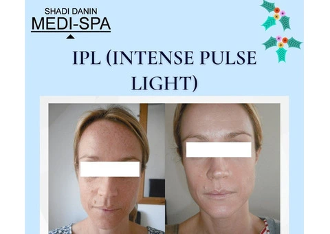 Revitalize Your Skin with Intense Pulsed Light Treatment in Brighton!