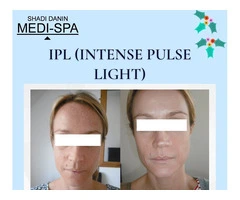 Revitalize Your Skin with Intense Pulsed Light Treatment in Brighton!