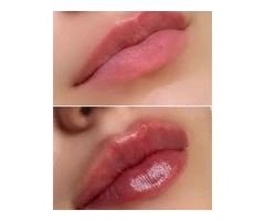 Dermal Fillers Cost London