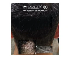 Scalp Micropigmentation For Scars