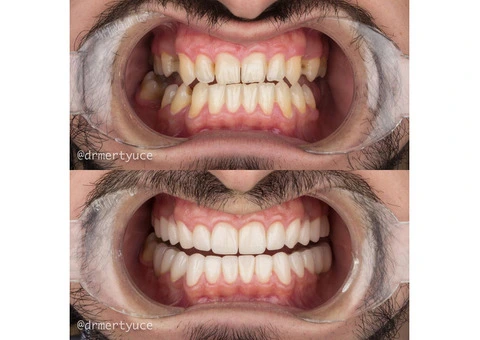 Want Smile: Turkey's Premier Dental Treatment Destination! - 1/4