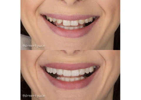 Want Smile: Turkey's Premier Dental Treatment Destination! - 2/4