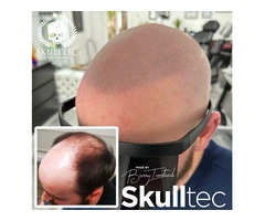 Hairline Restoration With Scalp Micropigmentation
