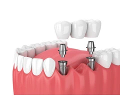 Southfield Dental Implants in Bournemouth