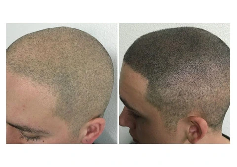 Scalp Micropigmentation For Thinning Hair