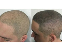 Scalp Micropigmentation For Thinning Hair