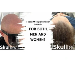 Scalp Micropigmentation For Men and Women
