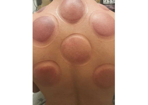 Hijama Training Course in London - 2/3