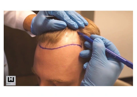 Get the Best Hair Transplant in Turkey with Want Hair!