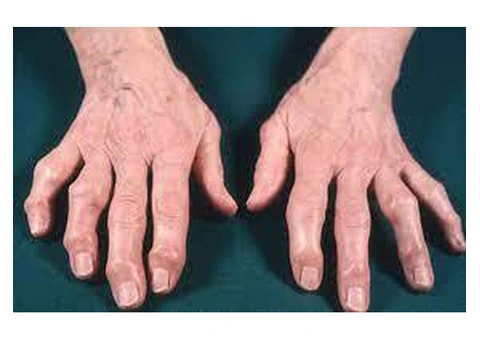 3. Advanced Hand Arthritis Treatments Available in Chester, UK