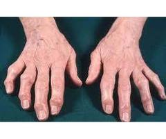 3. Advanced Hand Arthritis Treatments Available in Chester, UK