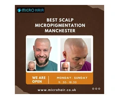 Best scalp micropigmentation Manchester