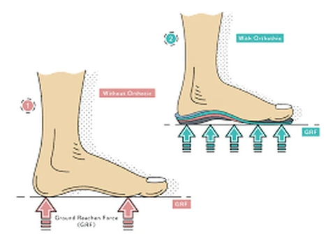 Best Custom Orthotics for Flat Feet – Alleviate Pain & Enhance
