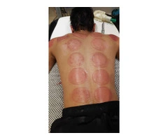 Professional Hijama Cupping Therapy Certificate Full Course