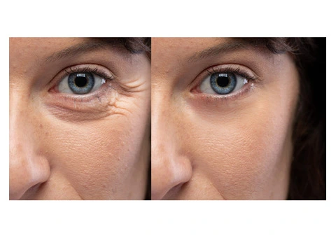 Dr Bela Clinic: Expert Mole Check, Removal, and Dermal Fillers in London