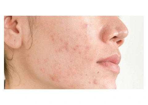 Discover the Power of Natural Acne Treatments in Merseyside - 1/3