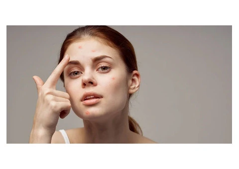 Discover the Power of Natural Acne Treatments in Merseyside - 2/3