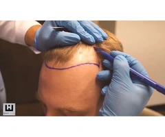 Get Your Confidence Back with a Hair Transplant in Turkey