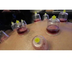 Enroll our Hijama Training Course
