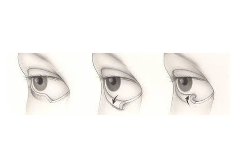 Contact Dr Pari Shams For Expert Entropion Repair