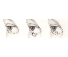 Ectropion Repair – Best Eyelid Surgery In UK