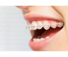 Transform your smile with invisible braces at ConfiDental Care