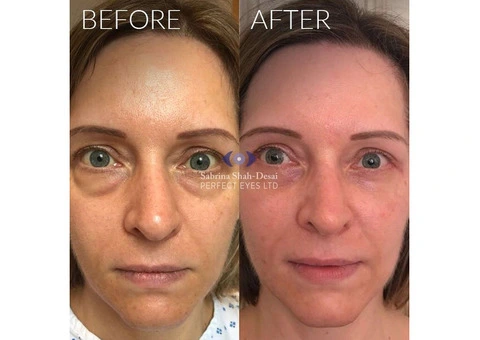 Eye Bag Removal in London - 2/3