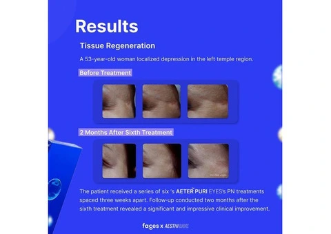 Pure Eyes Skin Booster - 5/11