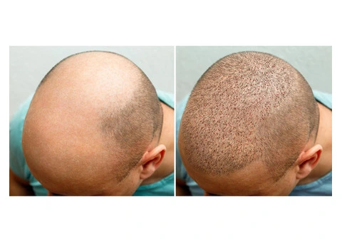 Hair Clinic in London – Expert Solutions for Hair Loss
