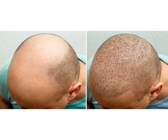 Hair Clinic in London – Expert Solutions for Hair Loss