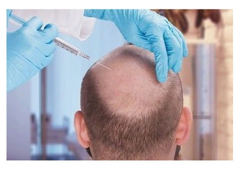 Affordable FUE Hair Transplant in the UK | Want Hair - Call 0113 418 2188
