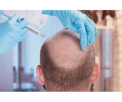Affordable FUE Hair Transplant in the UK | Want Hair - Call 0113 418 2188