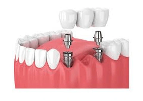 Affordable Bromley dental implants at ConfiDental Care