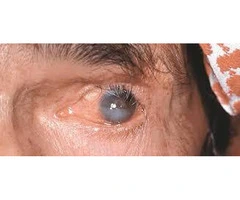 Abnormal Eyelashes (Trichiasis): Causes, Symptoms, And Treatments