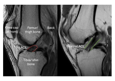 ACL Injuries London