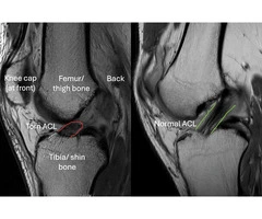 ACL Injuries London