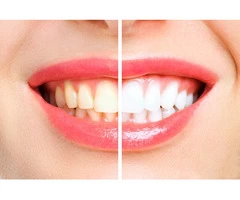 Which Teeth Whitening Service Is Right For You?