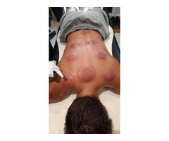 Hijama Therapy training course