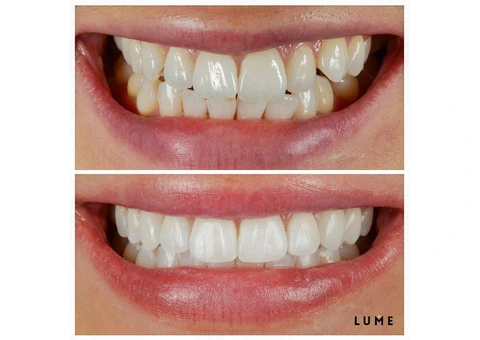 LUME DENTAL - 1/16